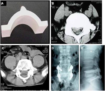 Artificial lamina after laminectomy: Progress, applications, and future perspectives